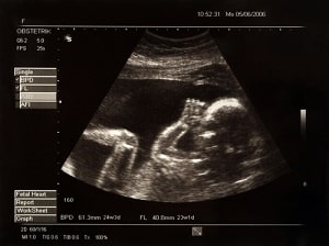 ultrasound of baby sucking its thumb